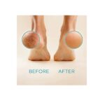 Lee Beauty Professional Best Callus Remover. Callus Eliminator, Liquid & Gel For Corn And Callus On Feet. Professional Grade - Image 7