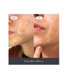 Mighty Patch Surface - Hydrocolloid Large Acne Pimple Patches Spot Treatment (Pack of 10) for Body and Larger Breakouts on Cheek, Forehead, Chin, Vegan, Cruelty-Free - Image 2