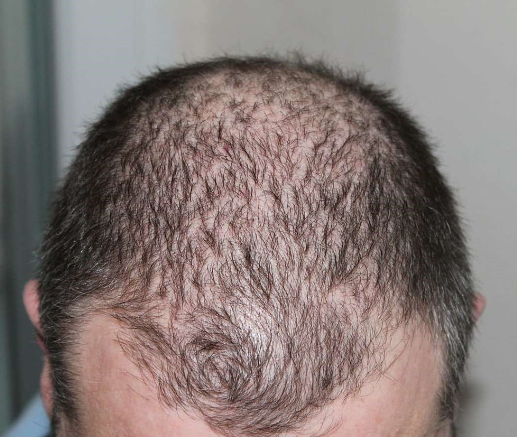 All-over thinning stage