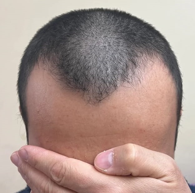 Receding hairline stage